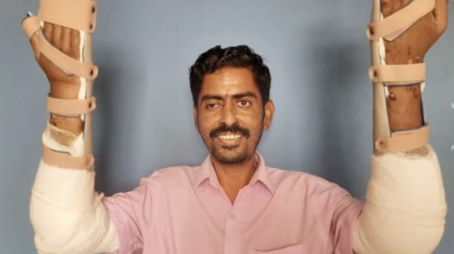 Double Transplantation Hemarina Patient après